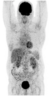 Умеренно выраженный правосторонний гидроторакс (увеличение в динамике) фото 4